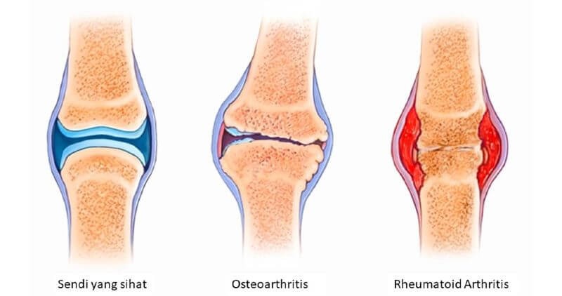 Rheumatoid Arthritis 