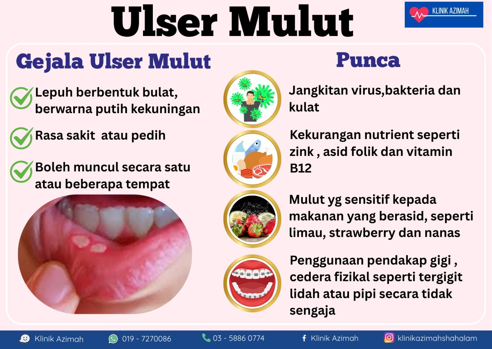 Ulser mulut dan lidah