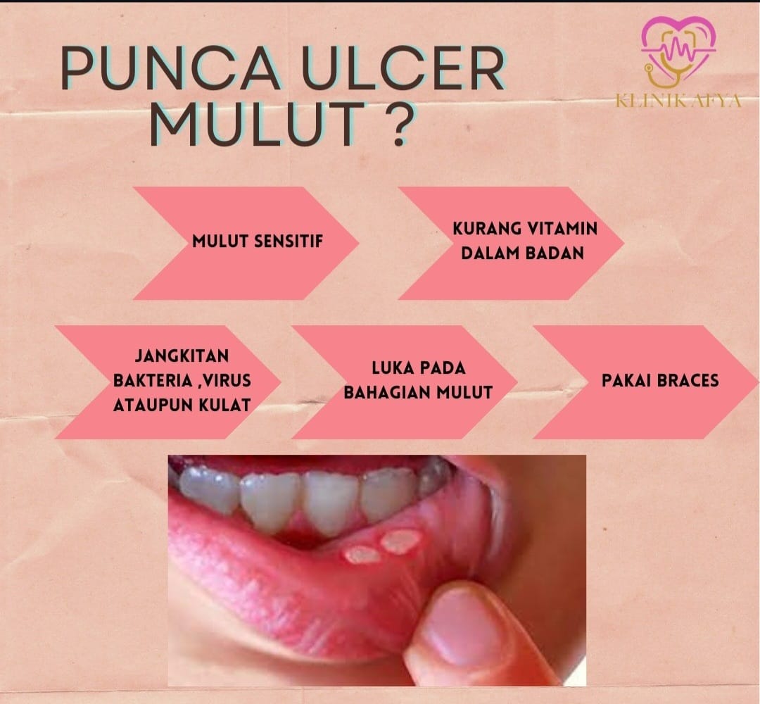 Ulser mulut dan lidah